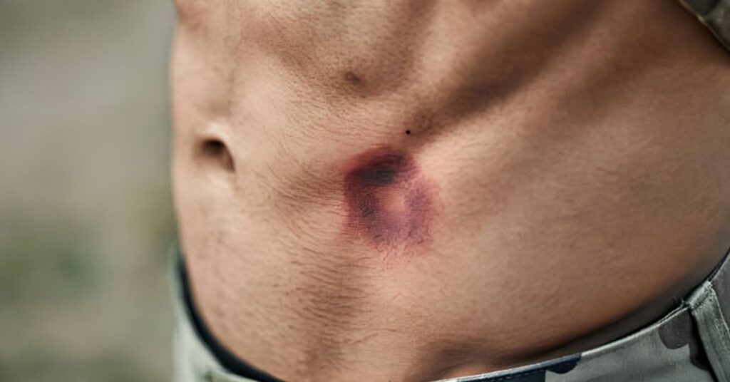 Paintball Bruises